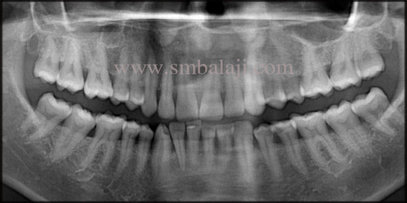 Pre-Operative Opg Shows Bone Loss At The Relative Site