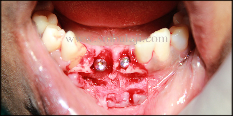 Dental Implants Fixed In The Underlying Bone At The Respective Site