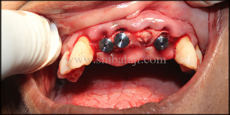 Dental Implants Placed In Upper And Lower Jaw