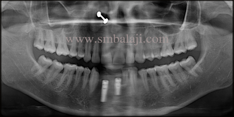 Post-Operative Opg Shows Well Osseointegrated Dental Implants