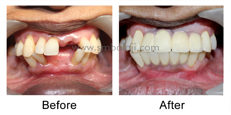 Dental Implants and Ceramic Crowns for Smile Makeover