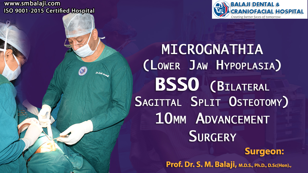 Micrognathia (Lower Jaw Hypoplasia) Bilateral Sagittal Split Osteotomy 10mm Advancement Surgery