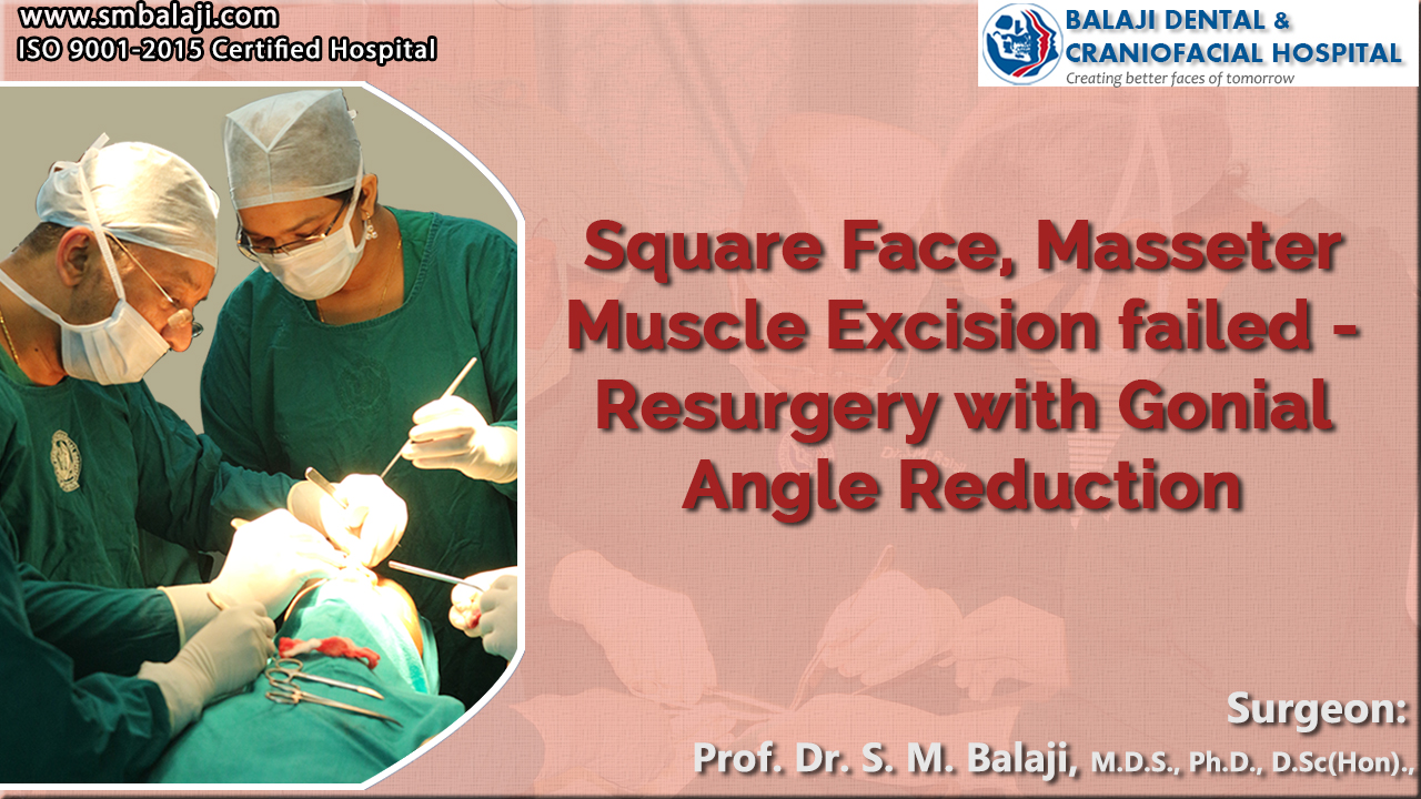 Square Face, Masseter Muscle Excision failed - Resurgery with Gonial Angle Reduction