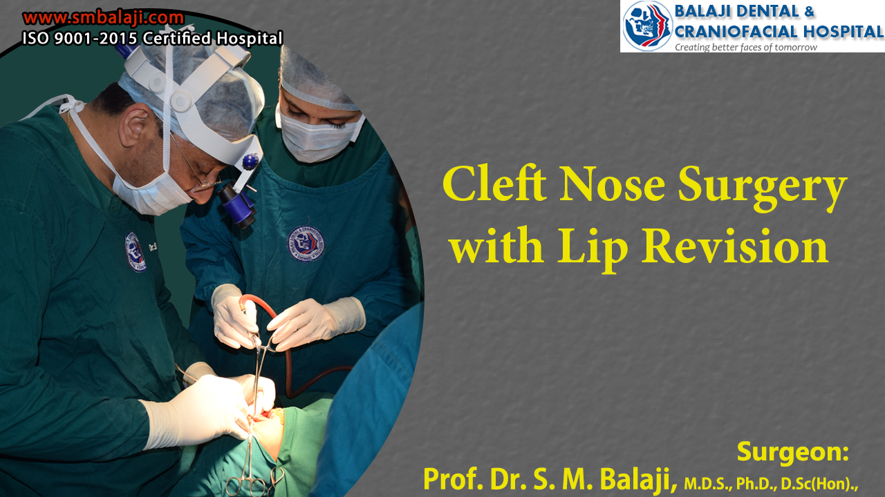 Cleft nose surgery with lip revision