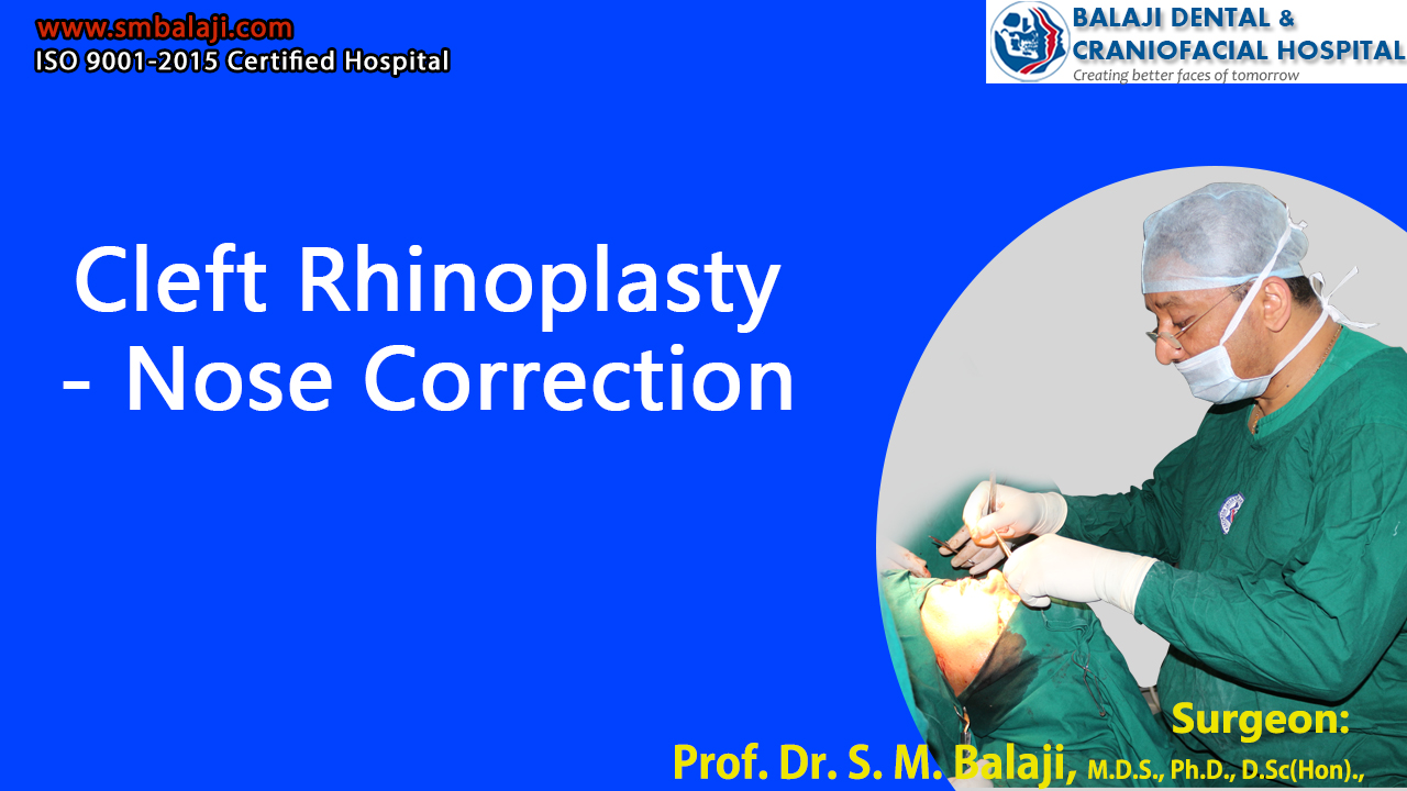 Cleft Rhinoplasty - Nose Correction