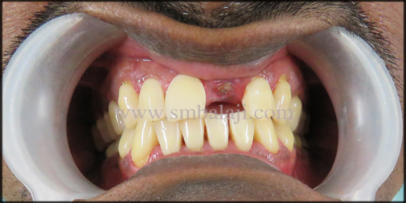 Patient With Broken Upper Front Tooth