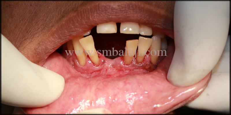 Replacement of compromised teeth and space closure with dental implants 1 Patient With Unpleasant Looking Lower Anteriors