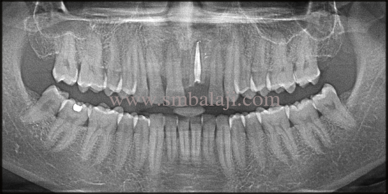 Pre Operative Opg Shows Root Canal Treated Tooth