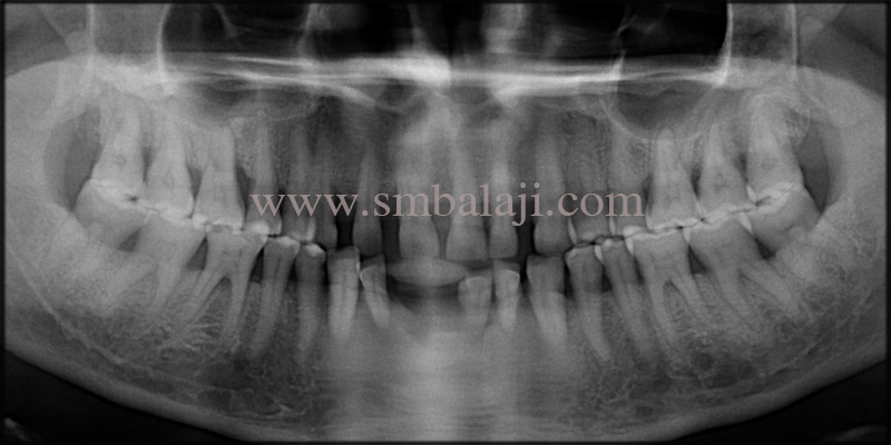 Pre-Operative Opg Shows Generalized Bone Loss In All Teeth