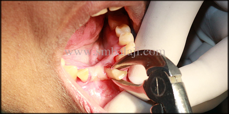 Extraction Of The Mobile Lower Front Teeth Under Local Anesthesia
