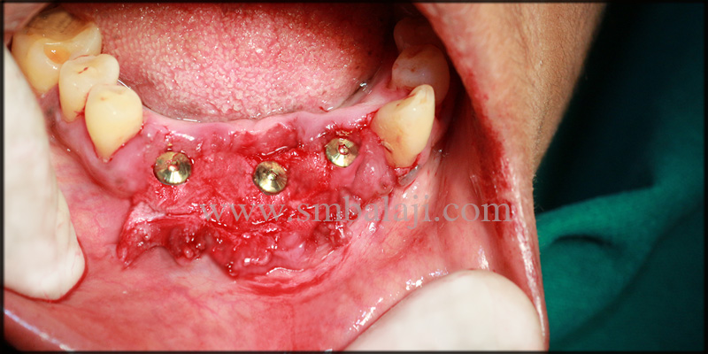 Dental Implants Fixed At The Relative Site With Stability