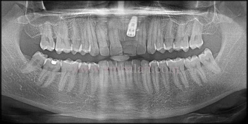 Post-Operative Opg Shows Osseointegrated Dental Implant