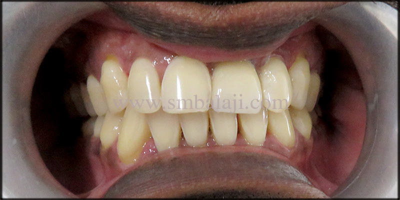 Natural Looking Prosthesis Fixed Onto The Dental Implant