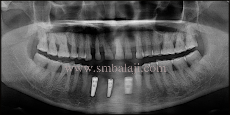 Post- Operative Opg Shows Well Osseointegrated Dental Implant