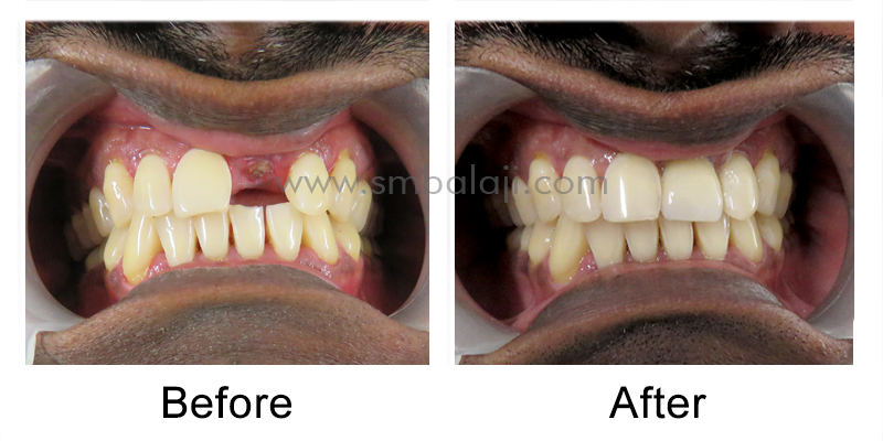 Replacement of broken root canal treated tooth with Dental Implant