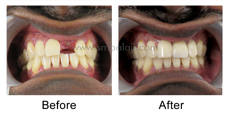 Patient before and after treatment