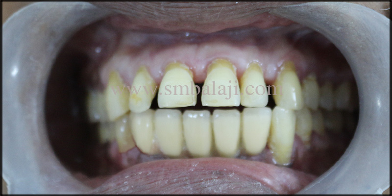 Well Aligned Natural Looking Fixed Ceramic Prosthesis