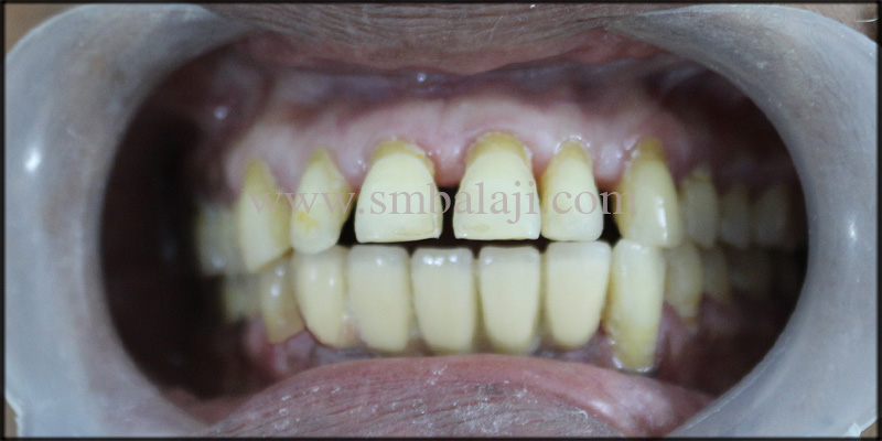 Replacement of compromised teeth and space closure with dental implants 6 Well Aligned Natural Looking Fixed Ceramic Prosthesis