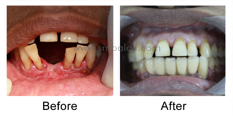 Replacement of compromised teeth and space closure with dental implants