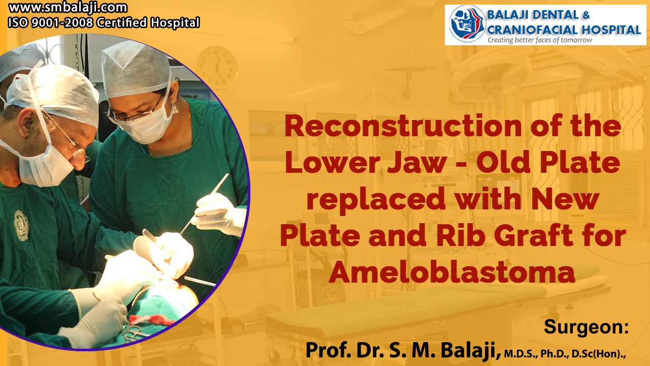 Reconstruction of the lower jaw - old plate replaced with new plate and rib graft for ameloblastoma