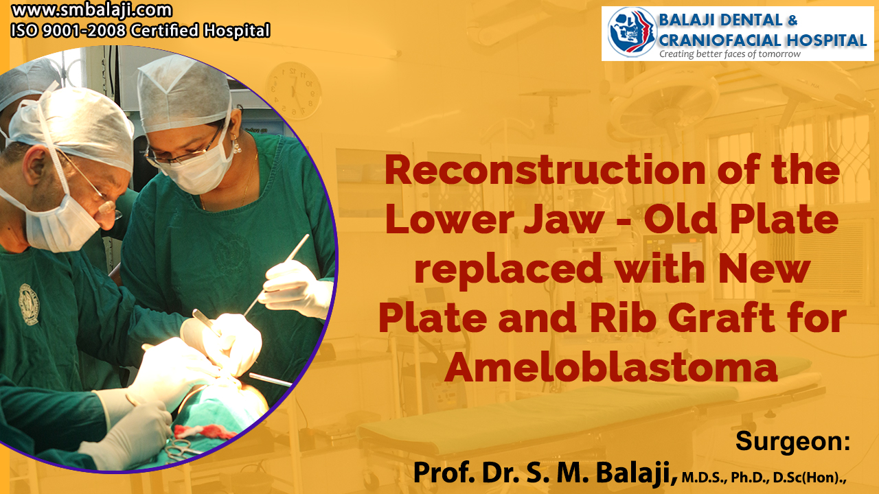 Reconstruction Of The Lower Jaw – Old Plate Replaced With New Plate And Rib Graft For Ameloblastoma