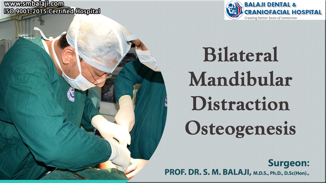 Bilateral Mandibular Distraction Osteogenesis