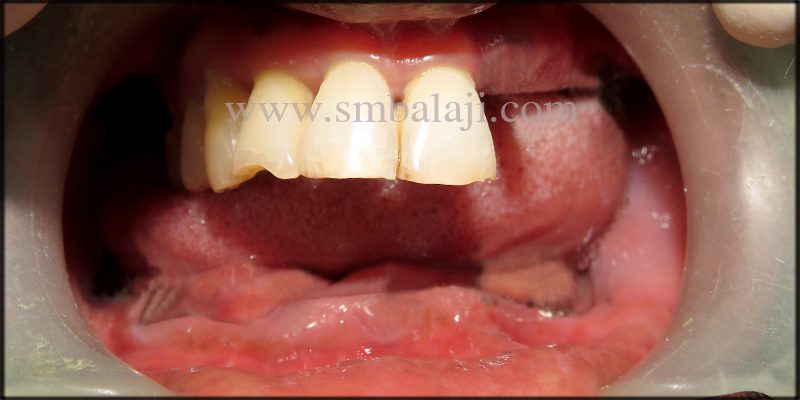 Patient With Missing Teeth In The Upper And Lower Jaw