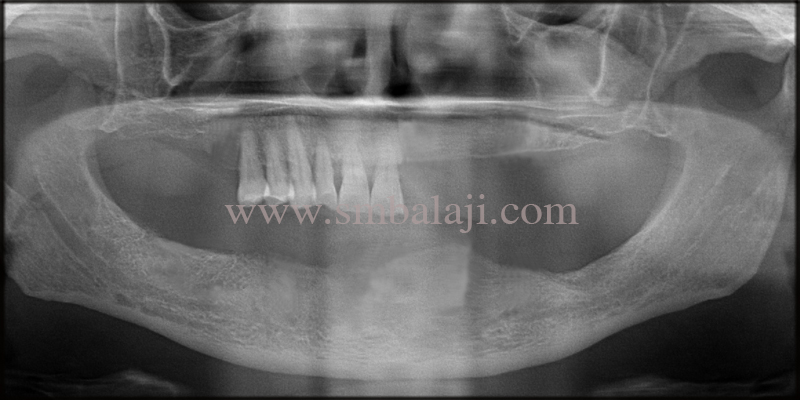 Opg Taken Shows Missing Teeth With Sufficient Bone Height For Dental Implant Placement