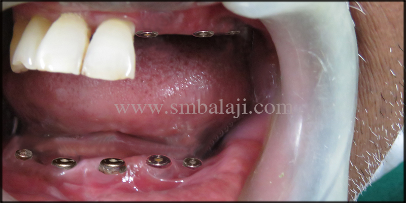 Dental Implants Placed At The Relative Site In The Upper And Lower Jaw