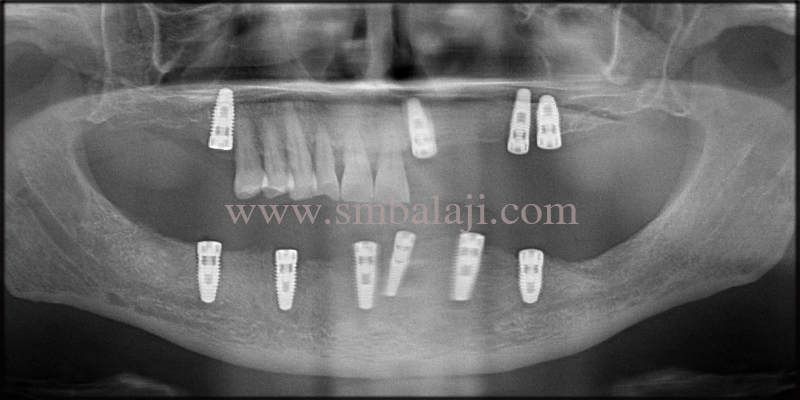 Post- Operative Opg Taken Shows Dental Implants Well Integrated With The Underlying Jaw Bone