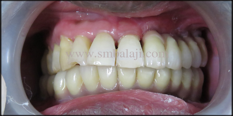 Natural Looking Fixed Ceramic Prosthesis Placed Onto The Dental Implants