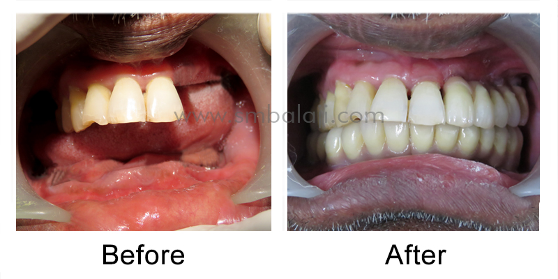 Oral Rehabilitation with Dental Implants