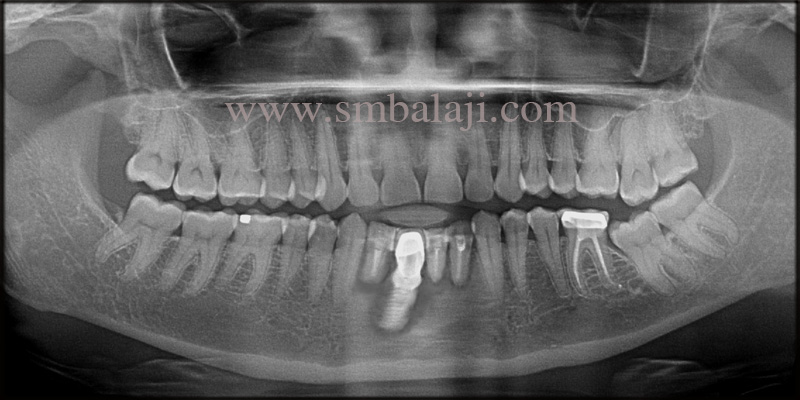 Pre-Operative Opg Shows Root Canal Treated Lower Anteriors And Infected Dental Implant