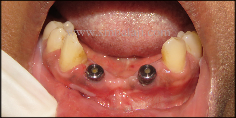 Dental Implants Of Perfect Size And Height Fixed In The Jaw Bone At The Involved Site