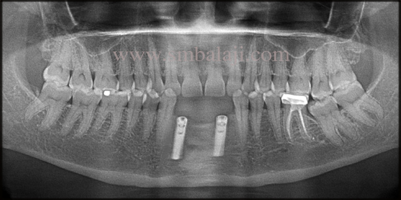 Post Operative Opg Shows Well Osseointegrated Dental Implants