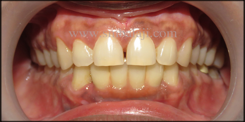 Natural Looking Prosthesis Fixed Onto The Dental Implants