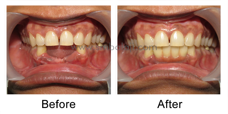 Patient before and after treatment outcome