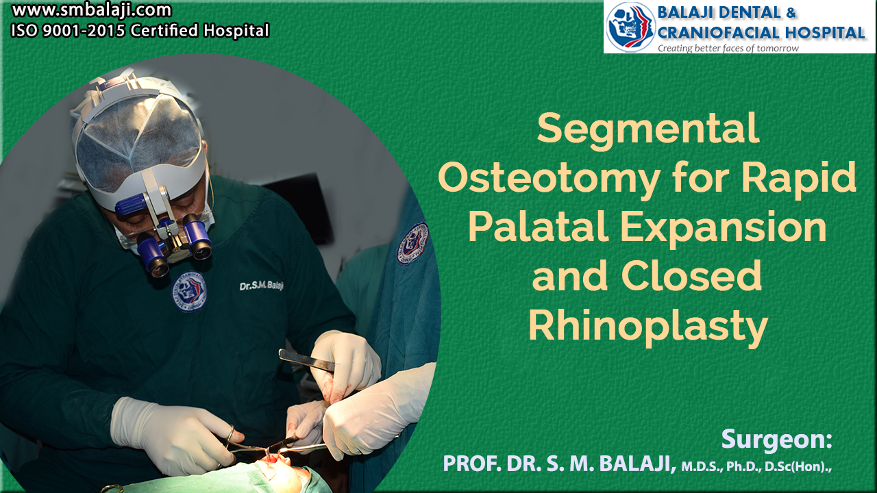 Segmental Osteotomy for Rapid Palatal Expansion and Closed Rhinoplasty