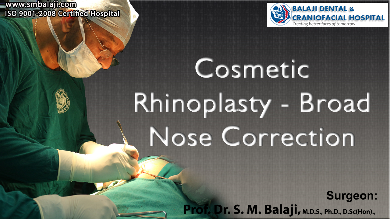 Cosmetic Rhinoplasty - Broad Nose Correction