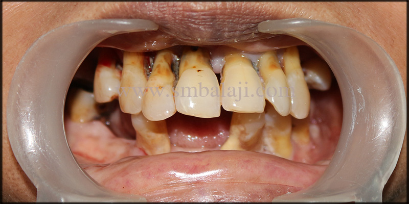 Unhappy Patient With Compromised Teeth Condition