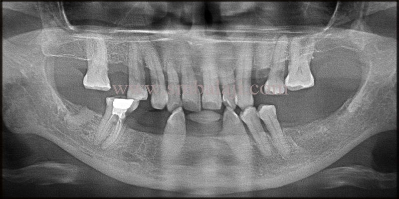 Pre-Operative Opg Shows Bone Loss In Upper And Lower Jaw