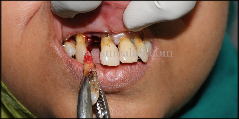 Extraction Of Mobile Teeth Done Under Local Anesthesia In Upper And Lower Jaw