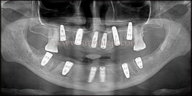 Post Operative Opg Shows Well Osseointegrated Dental Implants