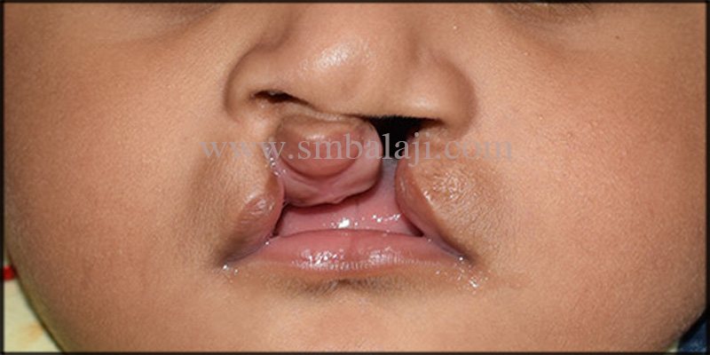 Bilateral Cleft Lip In A 3 Months Old Baby Boy