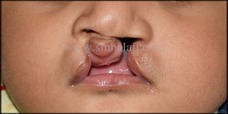Successful correction of bilateral cleft lip 1 Bilateral Cleft Lip In A 3 Months Old Baby Boy
