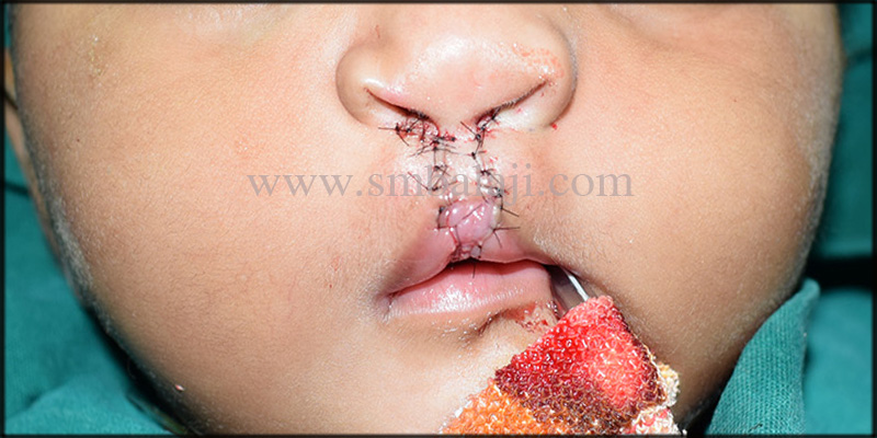 Successful correction of bilateral cleft lip 2 Primary Cleft Lip Repair Following Paul Black'S Technique