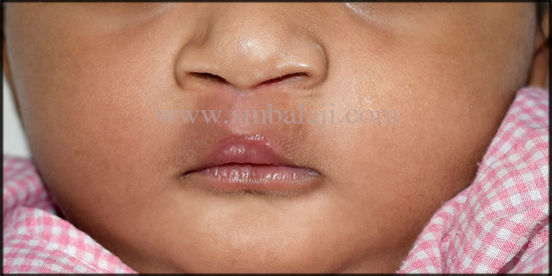 Successful correction of bilateral cleft lip 3 Immediately After Suture Removal Following Seven Days Of Surgery Showing Enhanced Appearance