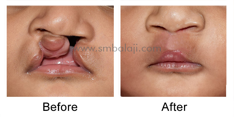 Successful Correction Of Bilateral Cleft Lip