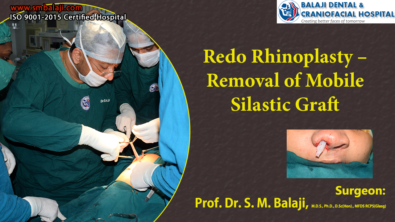 Redo Rhinoplasty – Removal of Mobile Silastic Graft