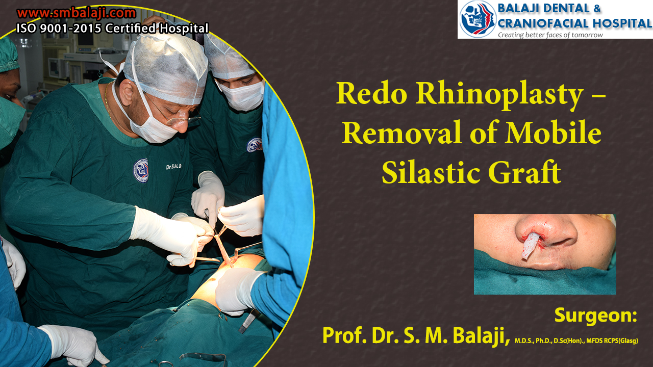 Redo Rhinoplasty – Removal Of Mobile Silastic Graft